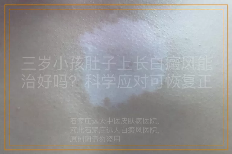 三岁小孩肚子上长白癜风能治好吗？科学应对可恢复正常肤色