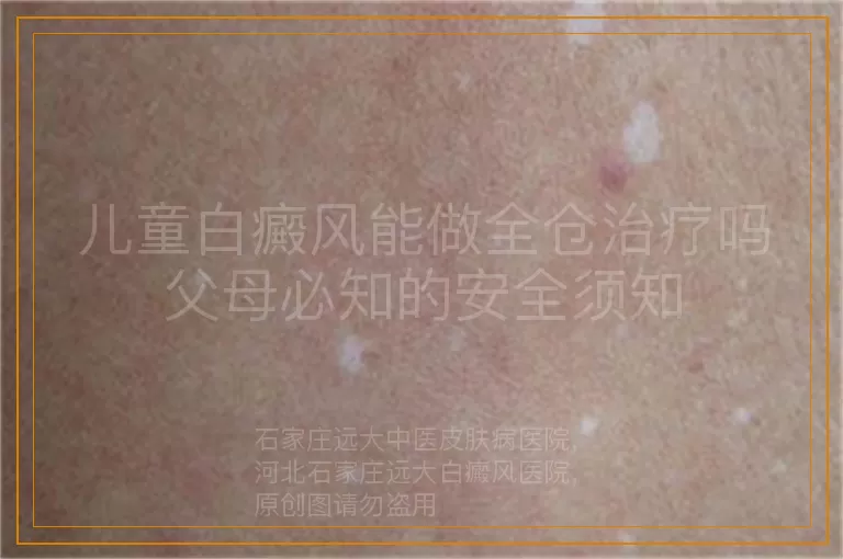 儿童白癜风能做全仓治疗吗父母必知的安全须知