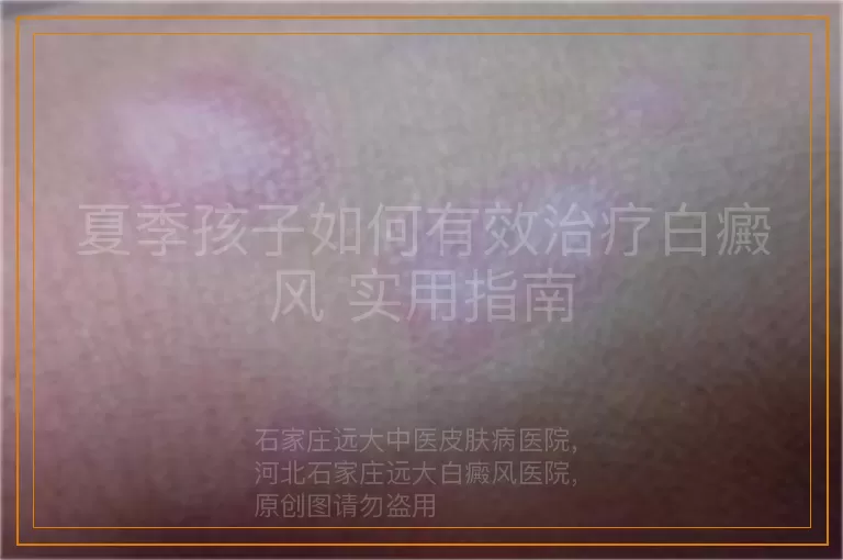 夏季孩子如何有效治疗白癜风 实用指南