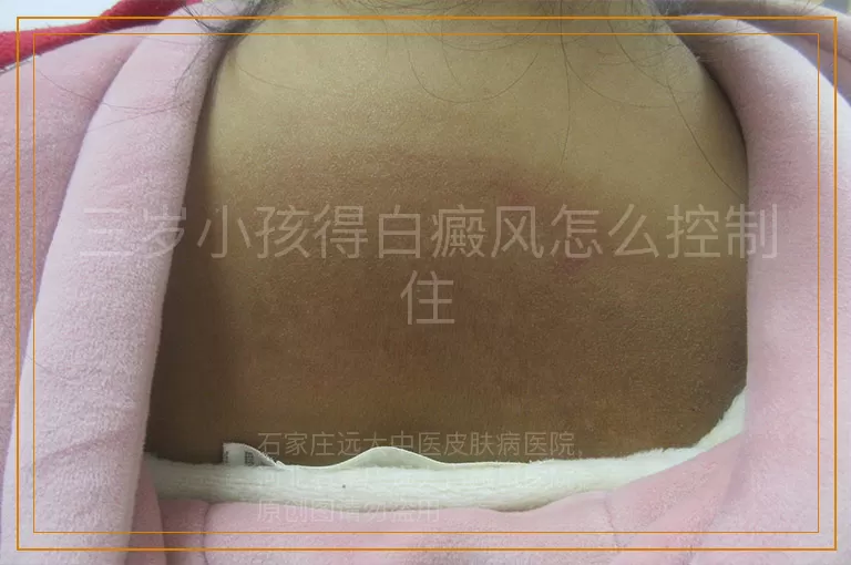 三岁小孩得白癜风怎么控制住