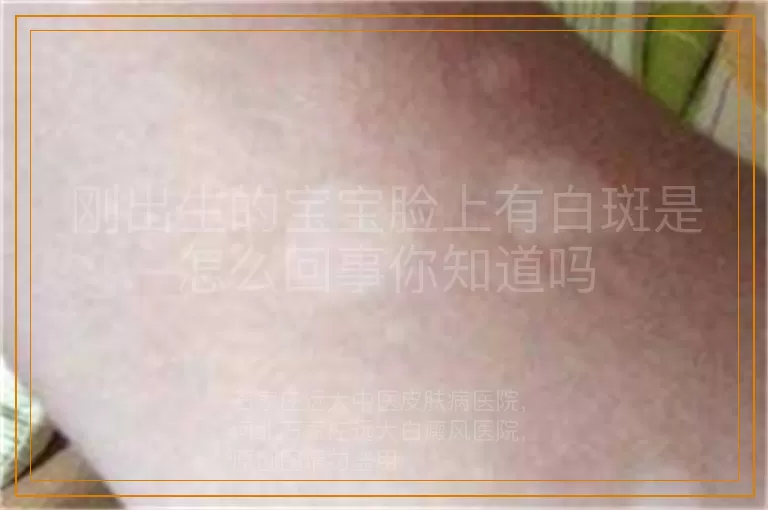 刚出生的宝宝脸上有白斑是怎么回事你知道吗