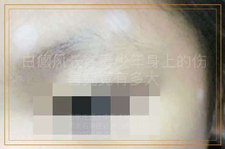 白癜风长在青少年身上的伤害究竟有多大