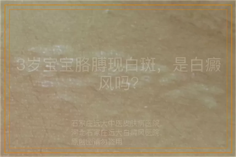 3岁宝宝胳膊现白斑，是白癜风吗？