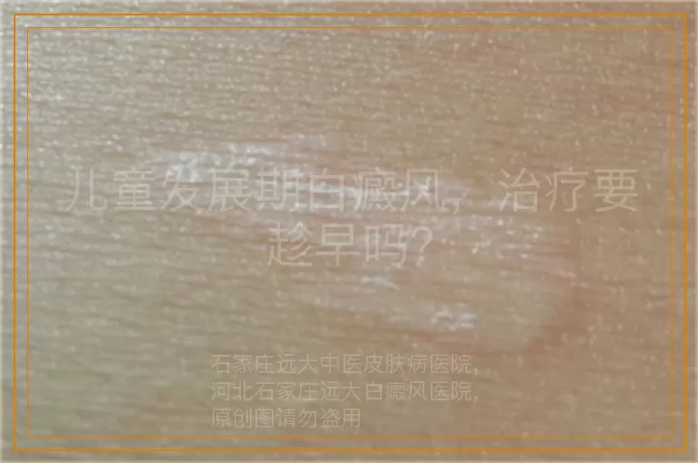 儿童发展期白癜风，治疗要趁早吗？