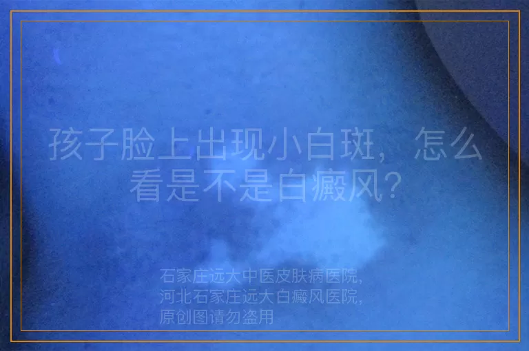 孩子脸上出现小白斑，怎么看是不是白癜风？