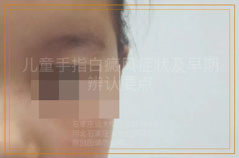 儿童手指白癜风症状及早期辨认要点