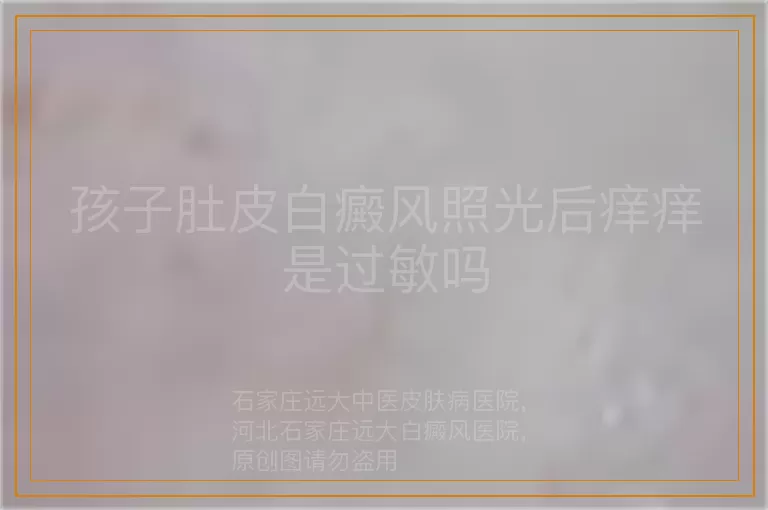孩子肚皮白癜风照光后痒痒是过敏吗