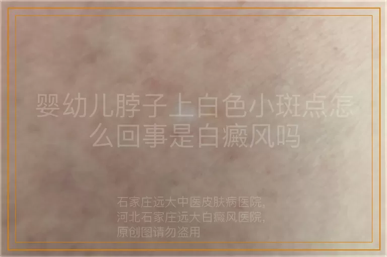 婴幼儿脖子上白色小斑点怎么回事是白癜风吗
