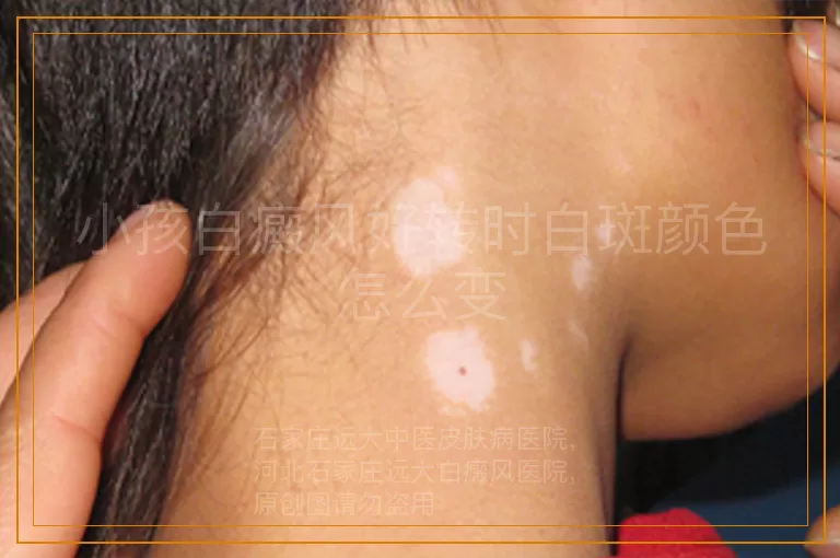 小孩白癜风好转时白斑颜色怎么变