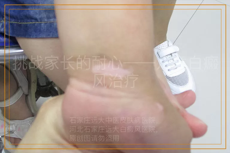 挑战家长的耐心——儿童白癜风治疗