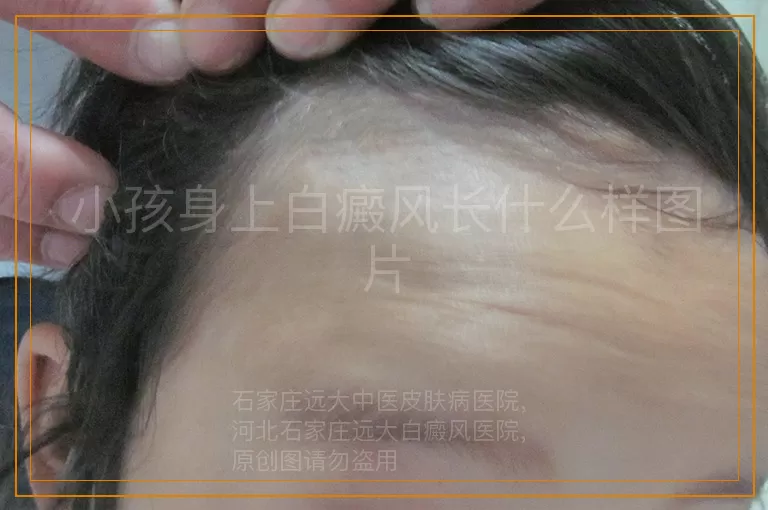 小孩身上白癜风长什么样图片