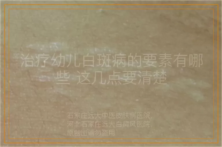 治疗幼儿白斑病的要素有哪些 这几点要清楚