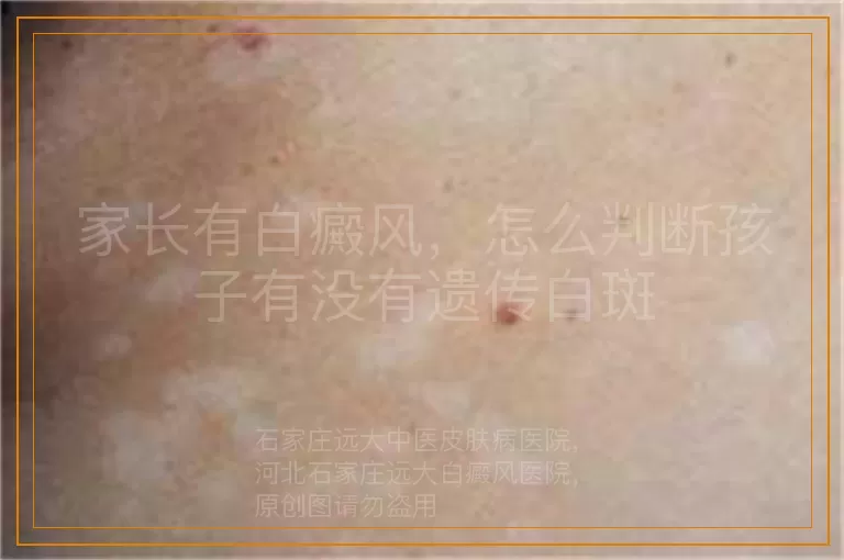 家长有白癜风，怎么判断孩子有没有遗传白斑