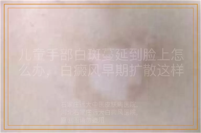 儿童手部白斑蔓延到脸上怎么办，白癜风早期扩散这样应对