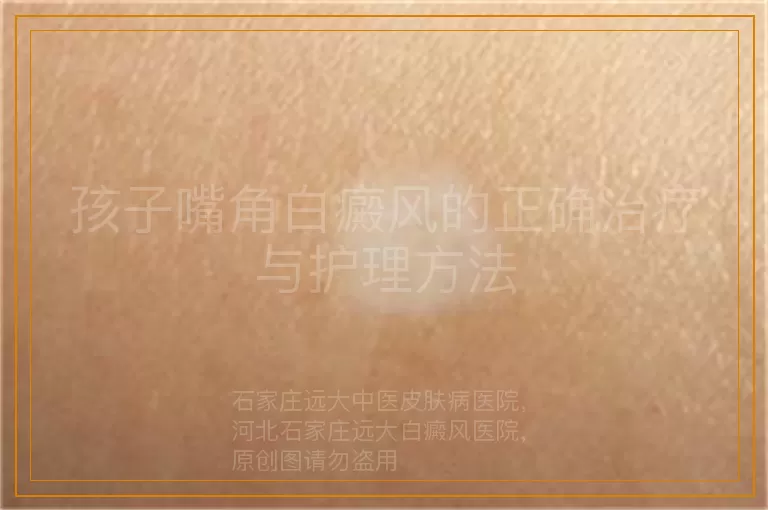 孩子嘴角白癜风的正确治疗与护理方法