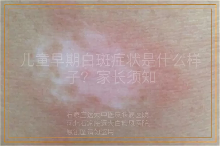 儿童早期白斑症状是什么样子？家长须知