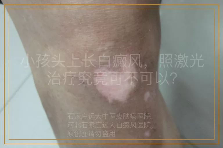小孩头上长白癜风，照激光治疗究竟可不可以？