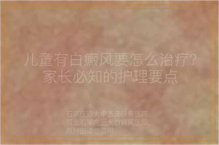 儿童有白癜风要怎么治疗？家长必知的护理要点