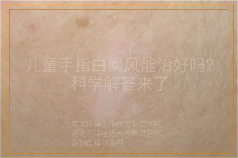 儿童手指白癜风能治好吗？科学解答来了