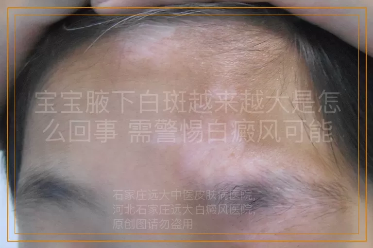 宝宝腋下白斑越来越大是怎么回事 需警惕白癜风可能