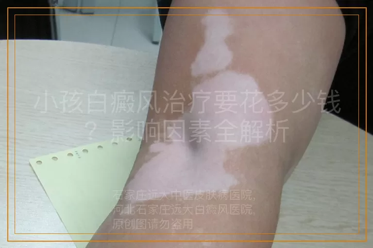 小孩白癜风治疗要花多少钱？影响因素全解析