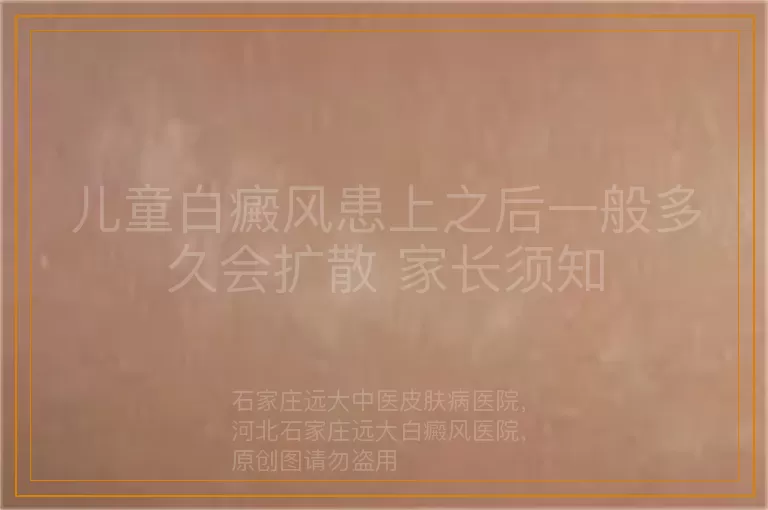 儿童白癜风患上之后一般多久会扩散 家长须知