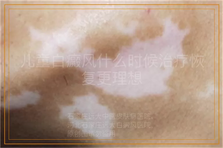 儿童白癜风什么时候治疗恢复更理想