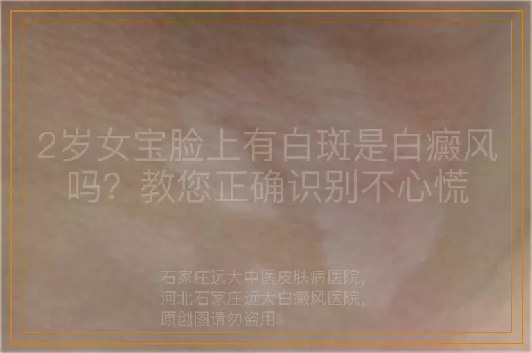2岁女宝脸上有白斑是白癜风吗？教您正确识别不心慌