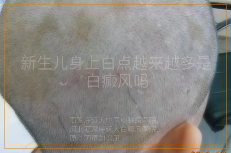 新生儿身上白点越来越多是白癜风吗