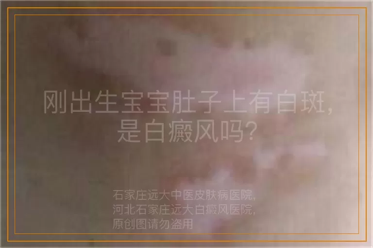 刚出生宝宝肚子上有白斑，是白癜风吗？