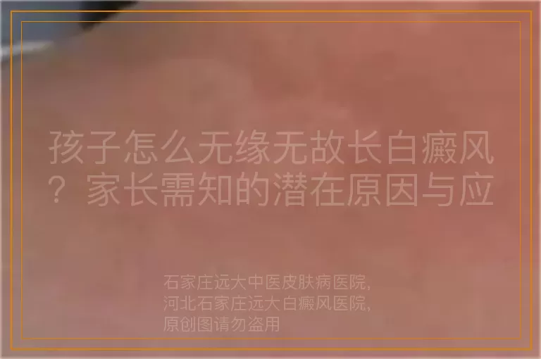 孩子怎么无缘无故长白癜风？家长需知的潜在原因与应对方法
