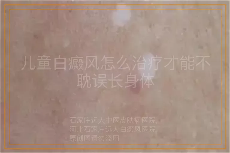儿童白癜风怎么治疗才能不耽误长身体