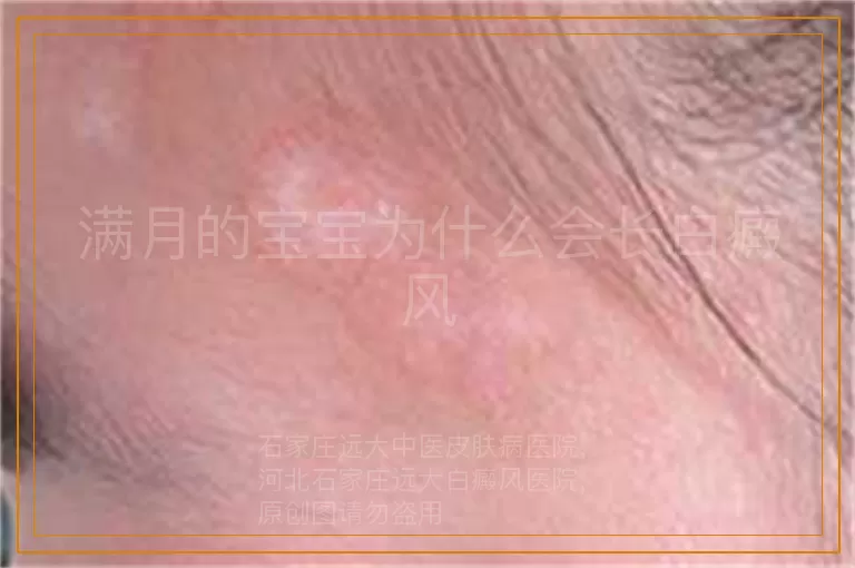 满月的宝宝为什么会长白癜风
