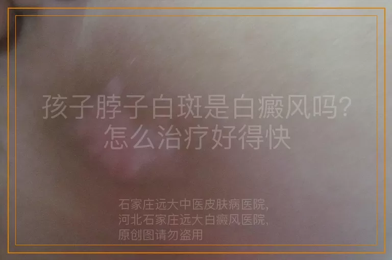 孩子脖子白斑是白癜风吗？怎么治疗好得快