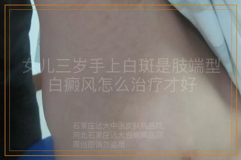 女儿三岁手上白斑是肢端型白癜风怎么治疗才好