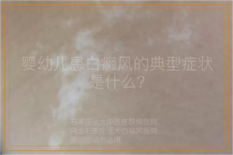 婴幼儿患白癜风的典型症状是什么？