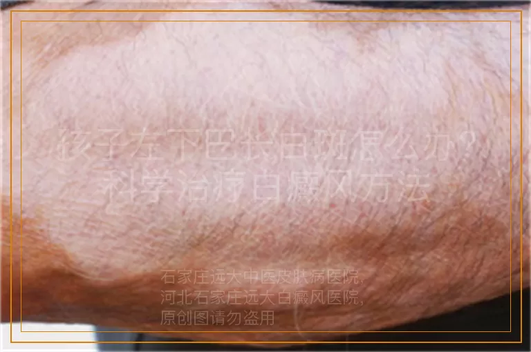 孩子左下巴长白斑怎么办？科学治疗白癜风方法