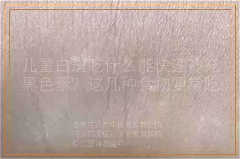 儿童白斑吃什么能快速补充黑色素？这几种食物要常吃