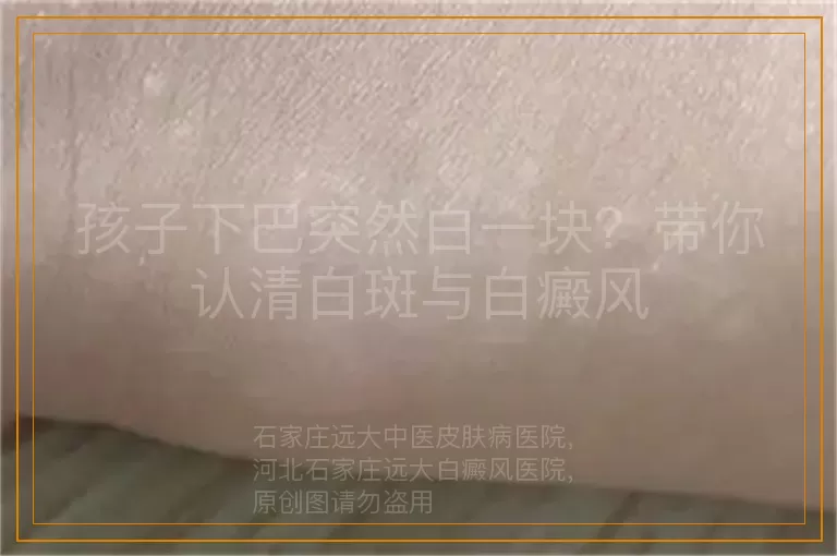 孩子下巴突然白一块？带你认清白斑与白癜风