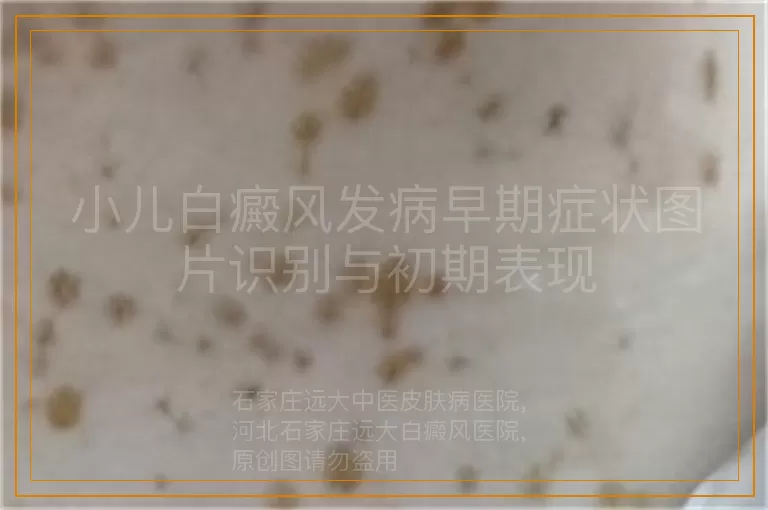 小儿白癜风发病早期症状图片识别与初期表现
