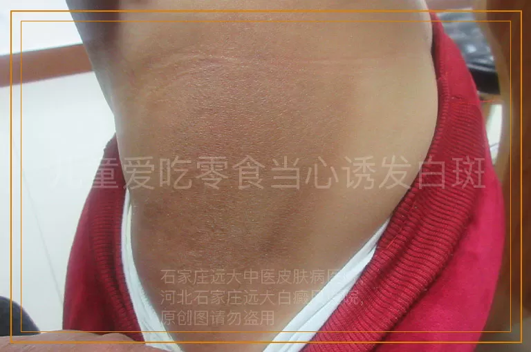 儿童爱吃零食当心诱发白斑
