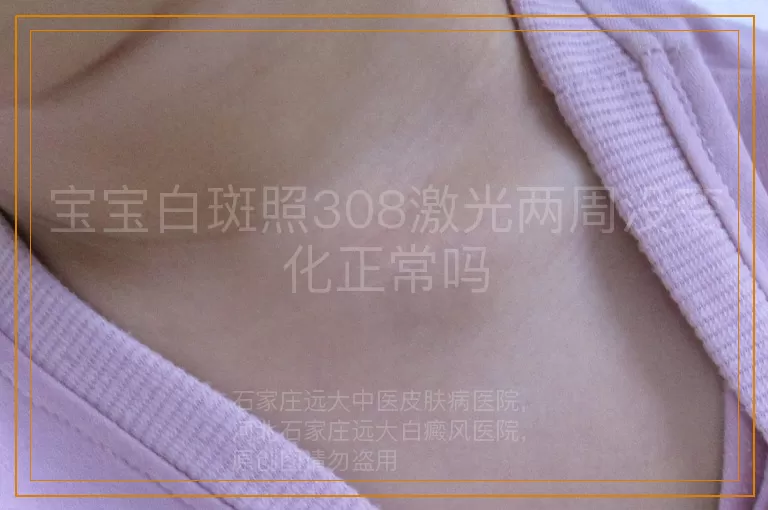 宝宝白斑照308激光两周没变化正常吗