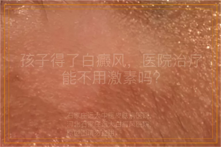 孩子得了白癜风，医院治疗能不用激素吗？