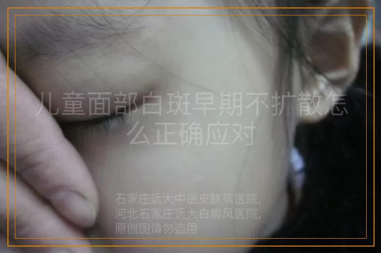 儿童面部白斑早期不扩散怎么正确应对