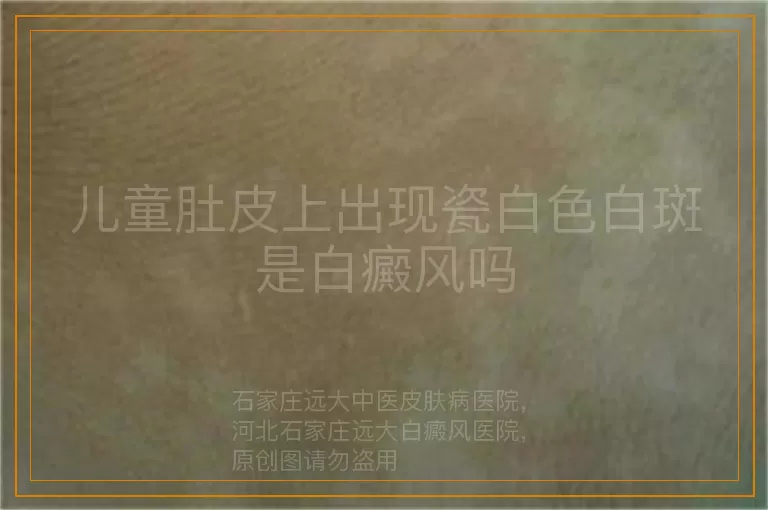 儿童肚皮上出现瓷白色白斑是白癜风吗