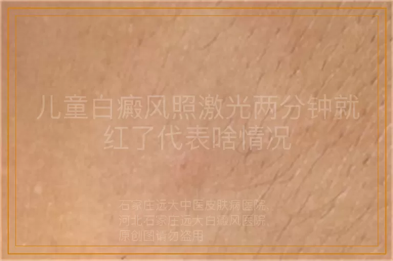 儿童白癜风照激光两分钟就红了代表啥情况