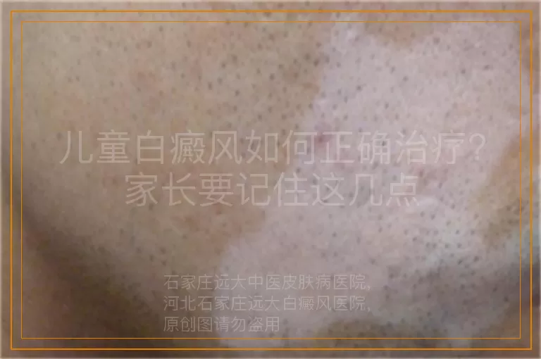 儿童白癜风如何正确治疗？家长要记住这几点