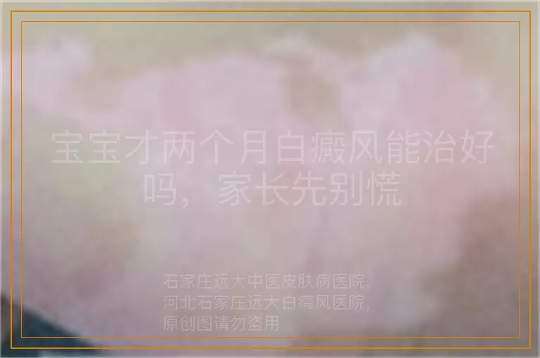 宝宝才两个月白癜风能治好吗，家长先别慌