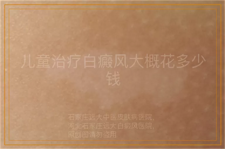 儿童治疗白癜风大概花多少钱