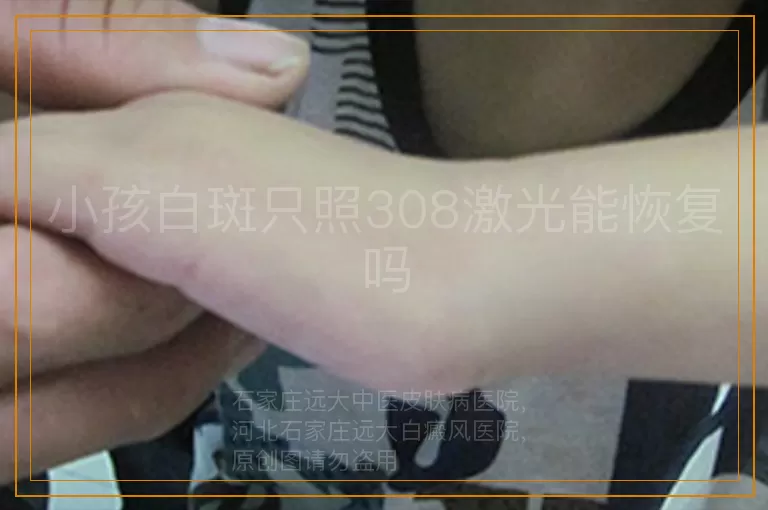 小孩白斑只照308激光能恢复吗